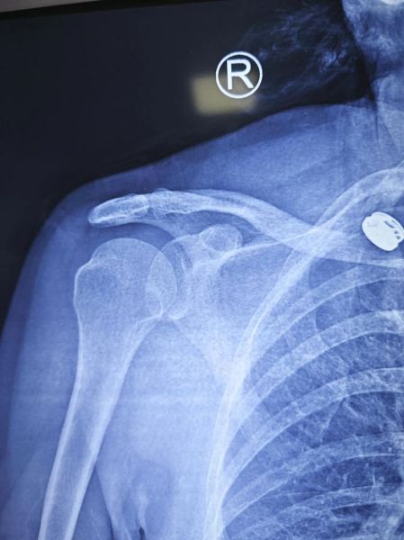 宝宝肩膀脱臼的症状_如何判断宝宝肩膀脱臼