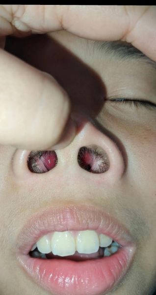 宝宝鼻子大正常吗_宝宝鼻子大怎么办