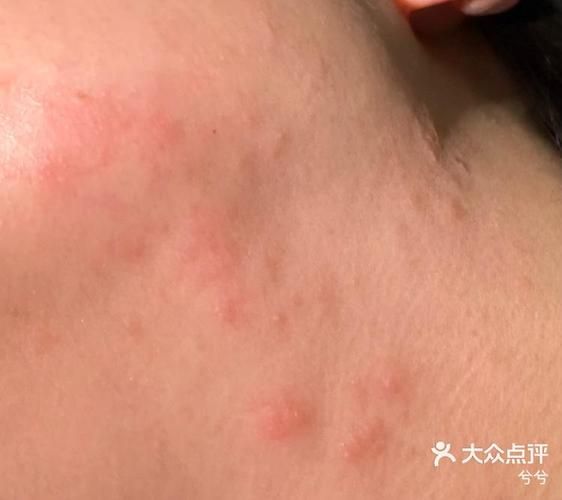 宝宝芒果过敏症状_如何处理宝宝芒果过敏