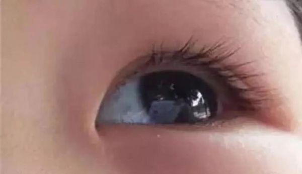 五个月宝宝眼白发蓝正常吗_婴儿眼白发蓝原因