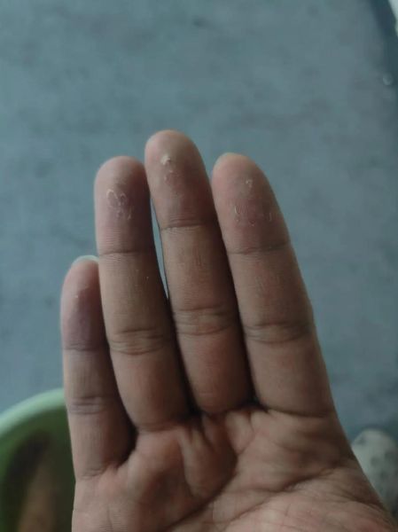 2岁宝宝手指脱皮是怎么回事_手指脱皮缺什么维生素