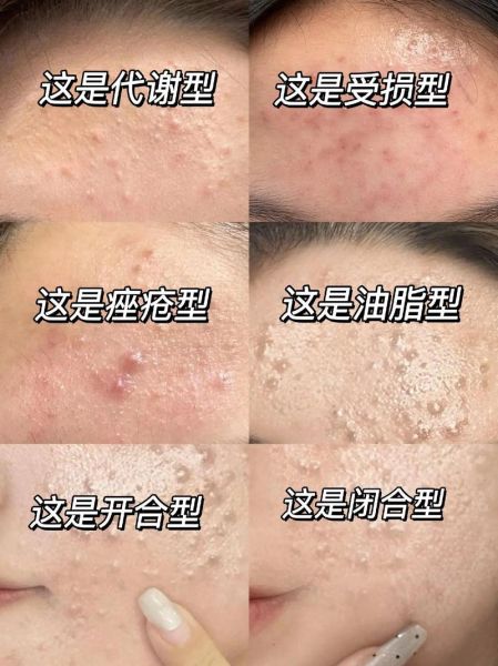 粉刺图片大全_粉刺怎么区分类型