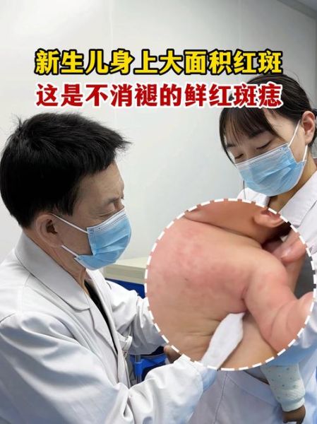 宝宝身上红斑怎么办_新生儿红斑多久能退