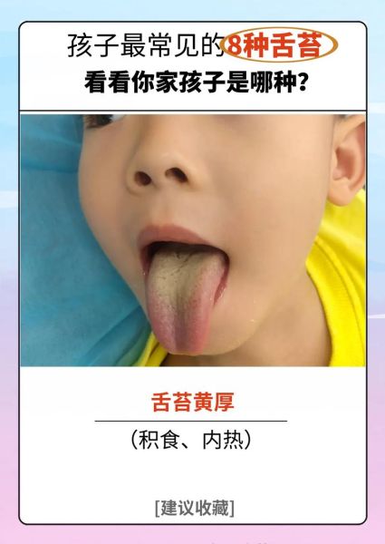 宝宝缺锌舌头图片_宝宝缺锌舌头有什么症状