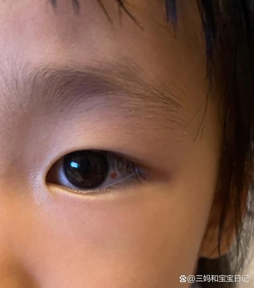 宝宝眼睛有红点怎么办_新生儿眼白红点原因