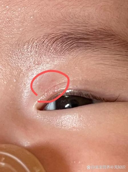 宝宝眼睛有红点怎么办_新生儿眼白红点原因