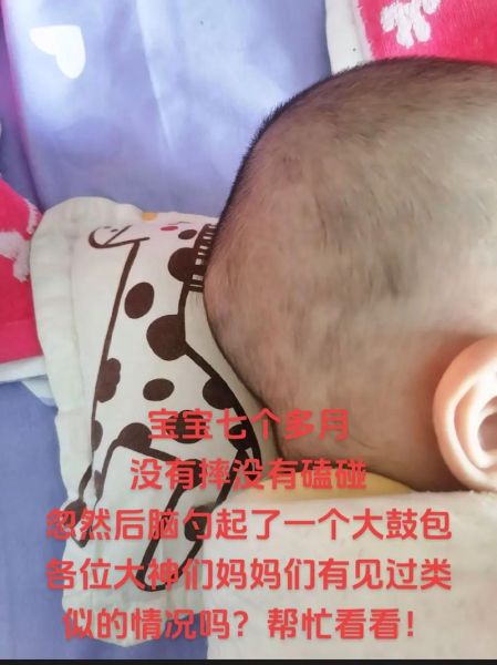 宝宝头上突然鼓起硬包怎么办_宝宝头上硬包多久能消