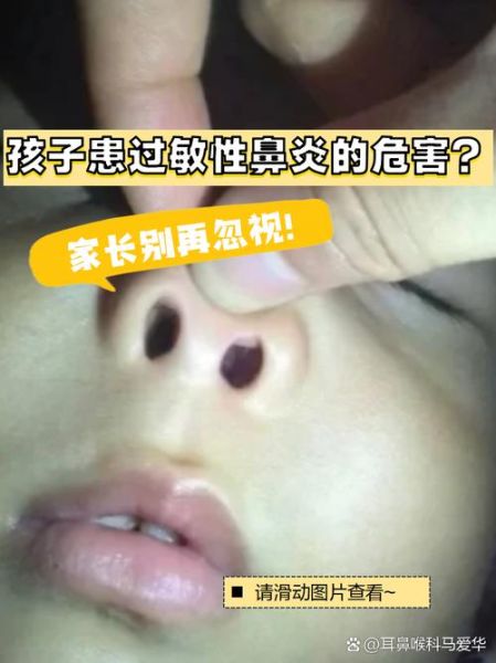 宝宝慢性鼻炎的症状_如何判断是过敏还是感冒