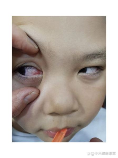 1岁宝宝眼睛有红血丝怎么办_1岁宝宝眼睛红血丝的原因