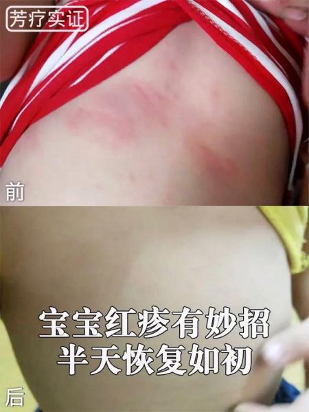 宝宝老抓肚子都抓红了_怎么办