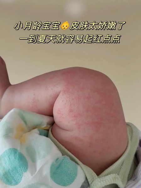 宝宝老抓肚子都抓红了_怎么办