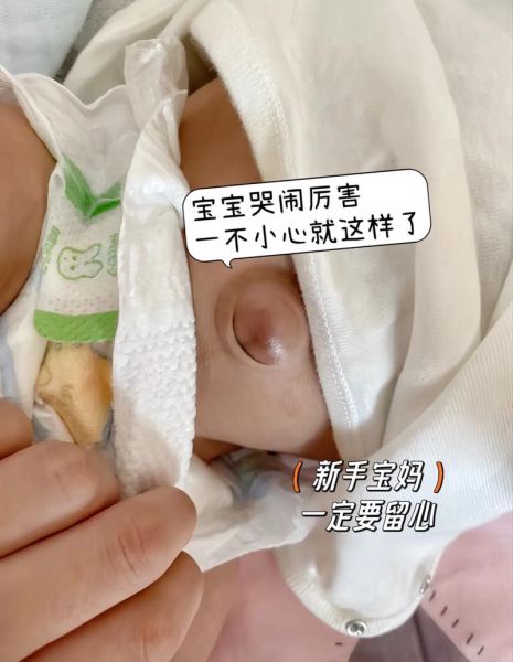 宝宝肚脐出水怎么回事_肚脐渗液怎么办
