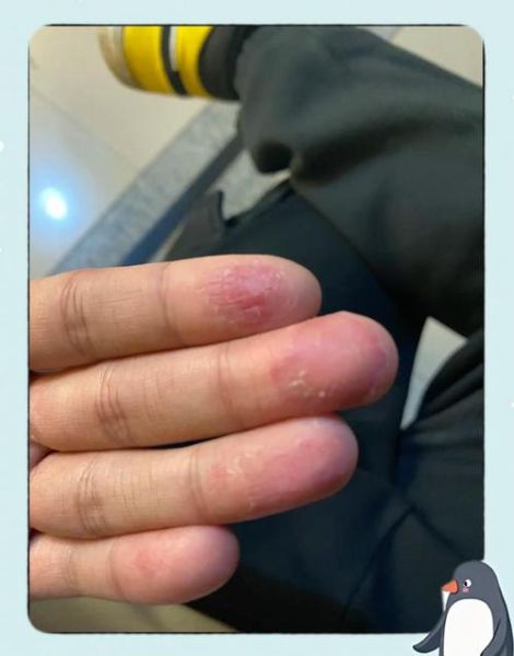 宝宝手指头脱皮是怎么回事_宝宝手指脱皮缺什么
