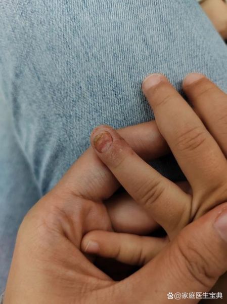 宝宝手指头脱皮是怎么回事_宝宝手指脱皮缺什么