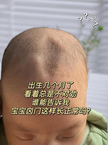 一岁宝宝卤门凹陷正常吗_卤门凹陷怎么办